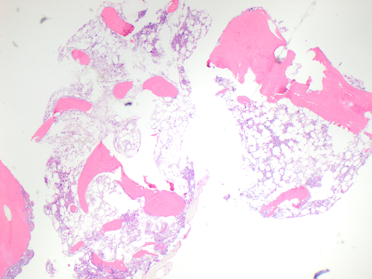 Specimen 2, BM core biopsy, H&E x 40